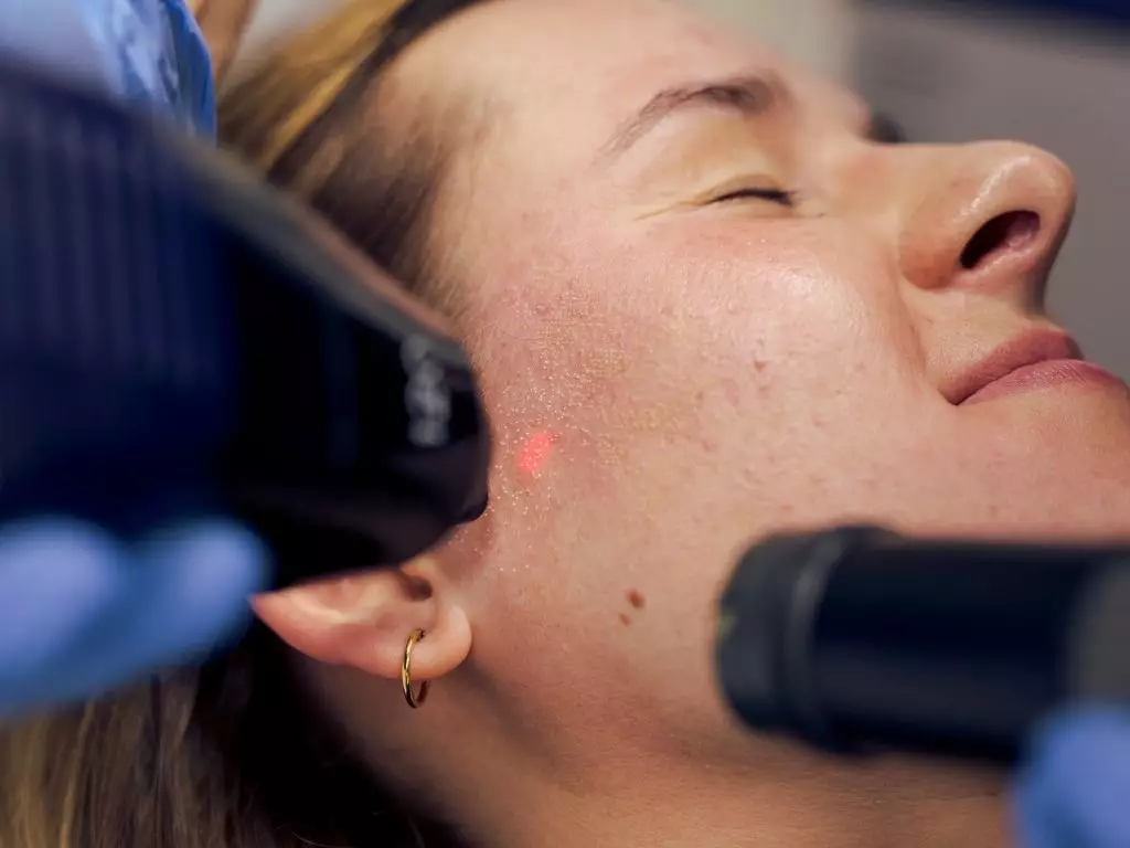 Biogenica medycyna estetyczna Poznań - laser frakcyjny co2